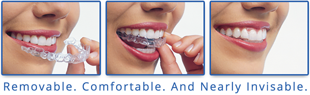 Invisalign treatment
